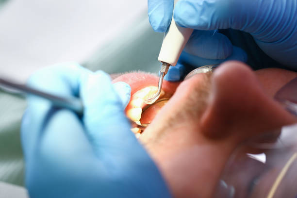 Best Emergency Dentist for Knocked-Out Tooth in Marceline, MO